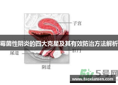 霉菌性阴炎的四大克星及其有效防治方法解析
